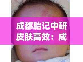 成都胎记中研皮肤高效:成都胎记医院