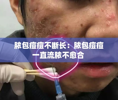 脓包痘痘不断长:脓包痘痘一直流脓不愈合