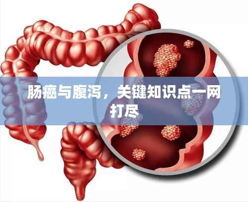 肠癌与腹泻，关键知识点一网打尽