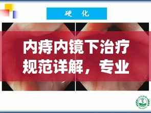 内痔内镜下治疗规范详解，专业指南引领新篇章！